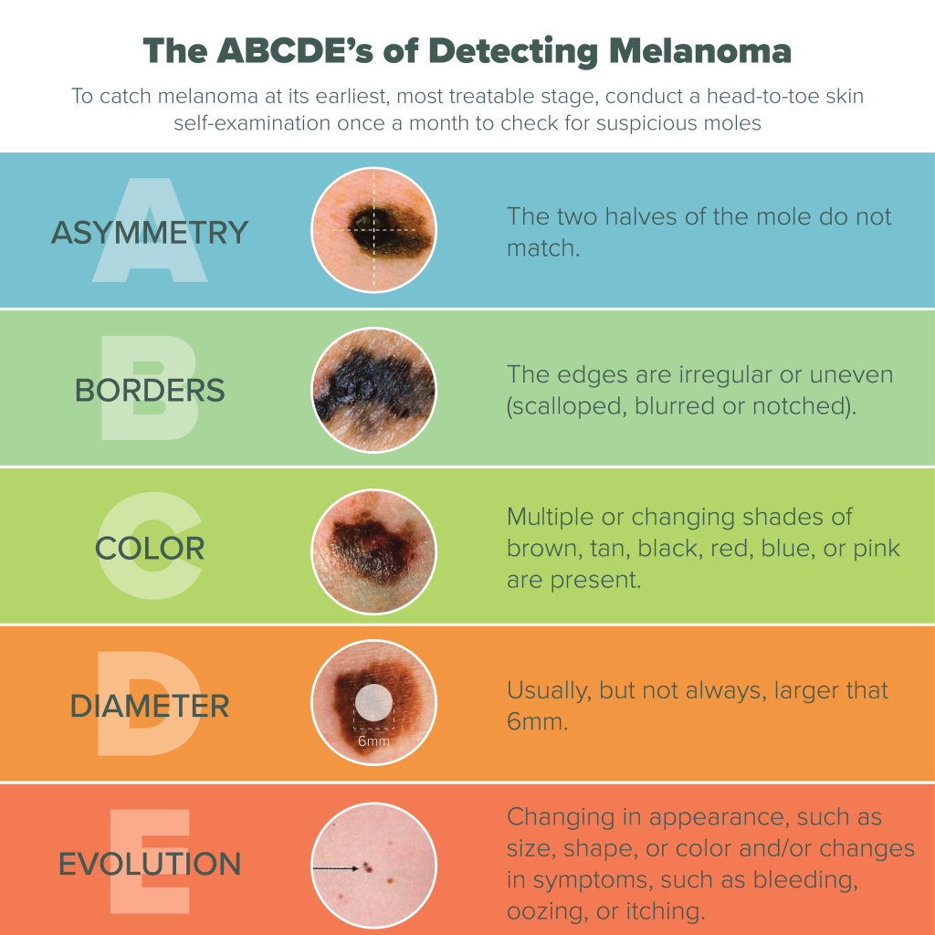 melanoma info