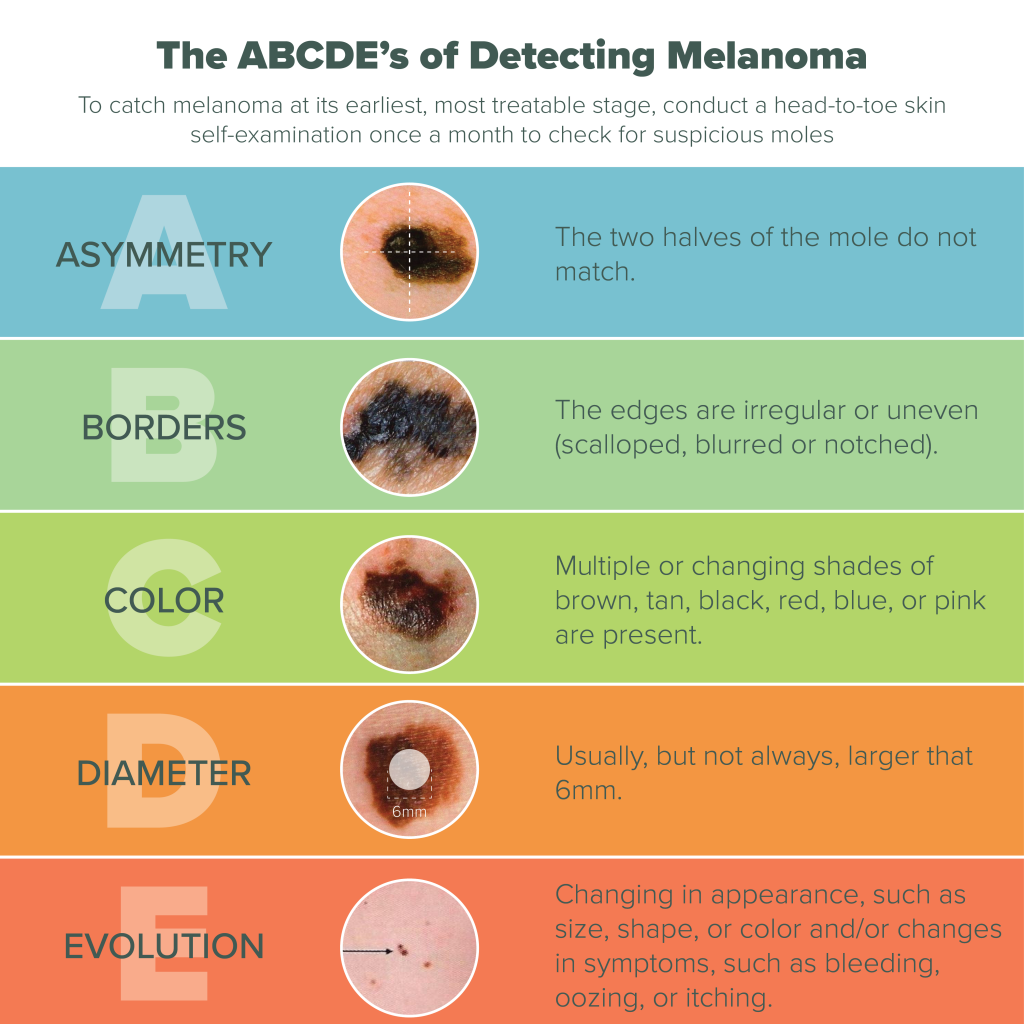 Melanoma Symptoms Abcde Doctor Heck